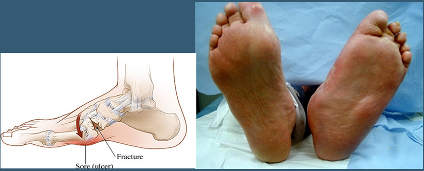 Charcot Foot Sole Remedy Foot Care